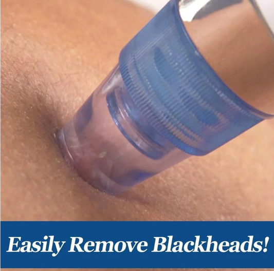 4-in-1 Blackhead Extractor – Vacuum Suction Acne Remover & Pore Cleaner